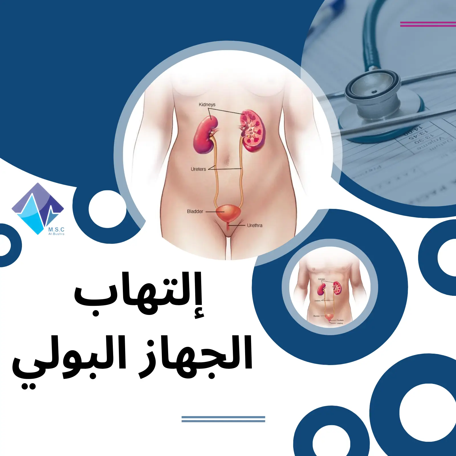 إلتهاب الجهاز البولي