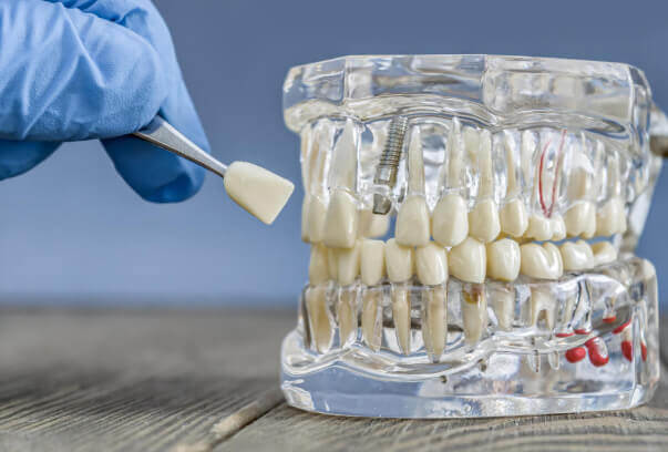 زراعة الاسنان في مسقط